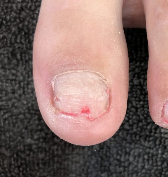 Step 1: Use sanitiser on the client’s feet and your hands. Remove any polish or product from the nail plate. Push back the eponichyium growth and use a 180-grit file to remove the shine from the nail plate.