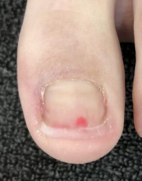 Step 6: Once fully cured, remove the form, file and buff into shape.  Ensure that the toe nail is kept straight and not rounded to avoid ingrowing toenails.