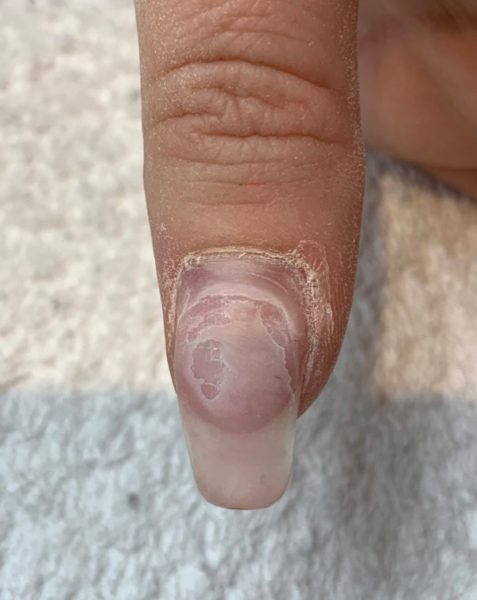 As the product was filed down, it revealed that a larger area was in fact lifted. When you notice any lifting, it is important to do this & not just cover over.