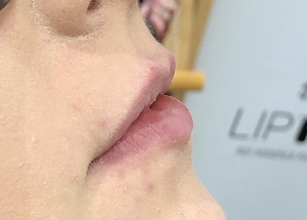 Kat: After Lip NV No Needle Filler treatment