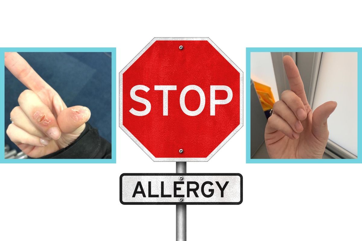 Allergy Katie Barnes