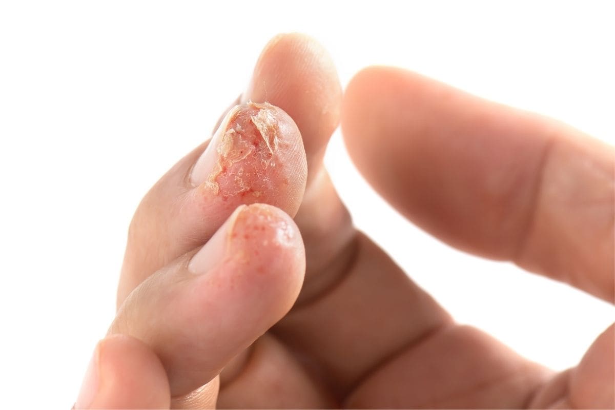 Katie Barnes Canva allergy