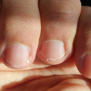Weak brittle ridged natural nails