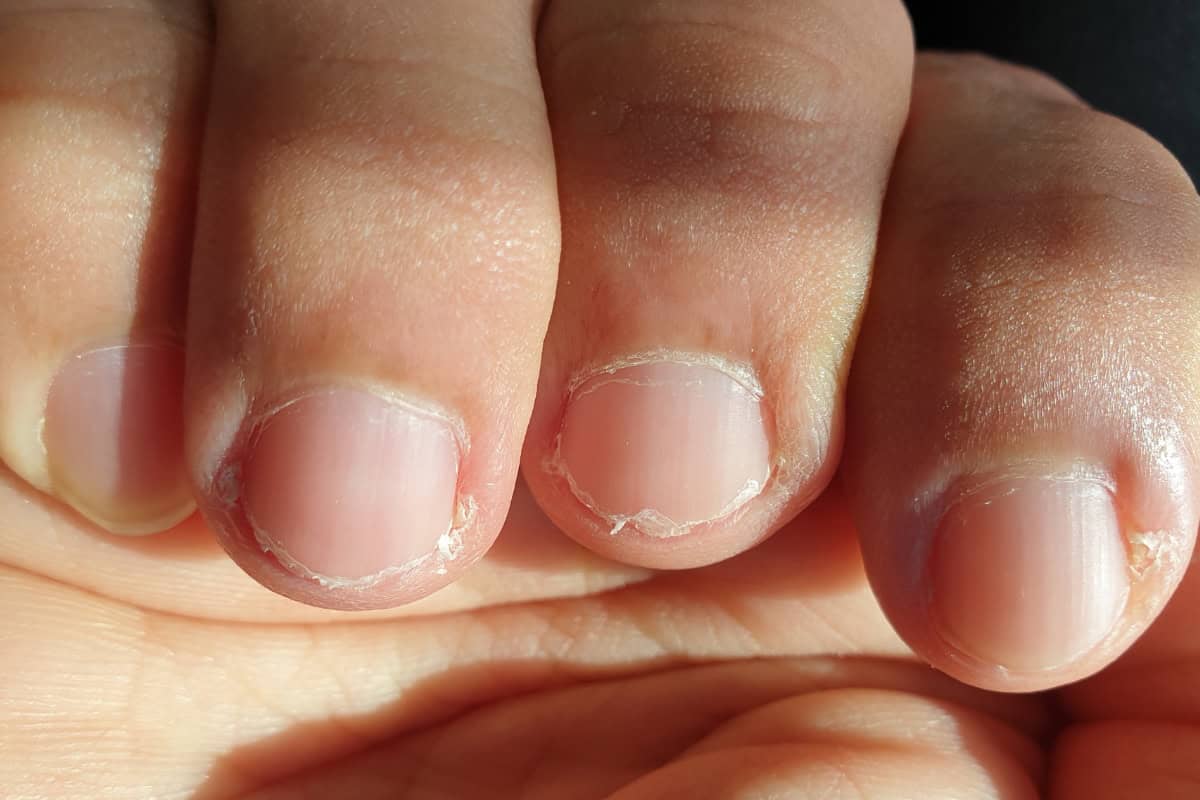 Weak brittle ridged natural nails