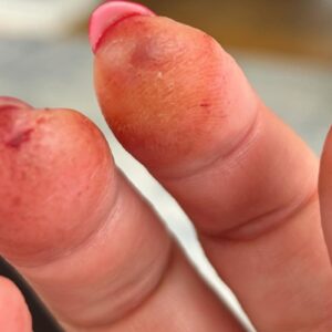 Gel irritation theresa foddering