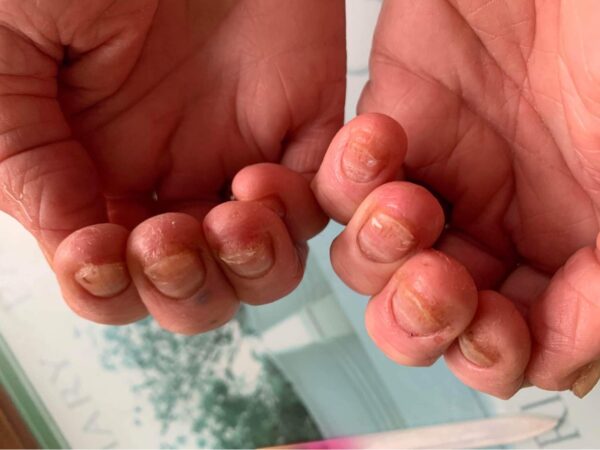 Severe prolonged overfiling